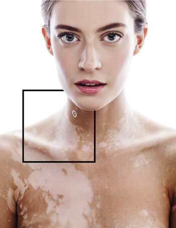 Vitiligo